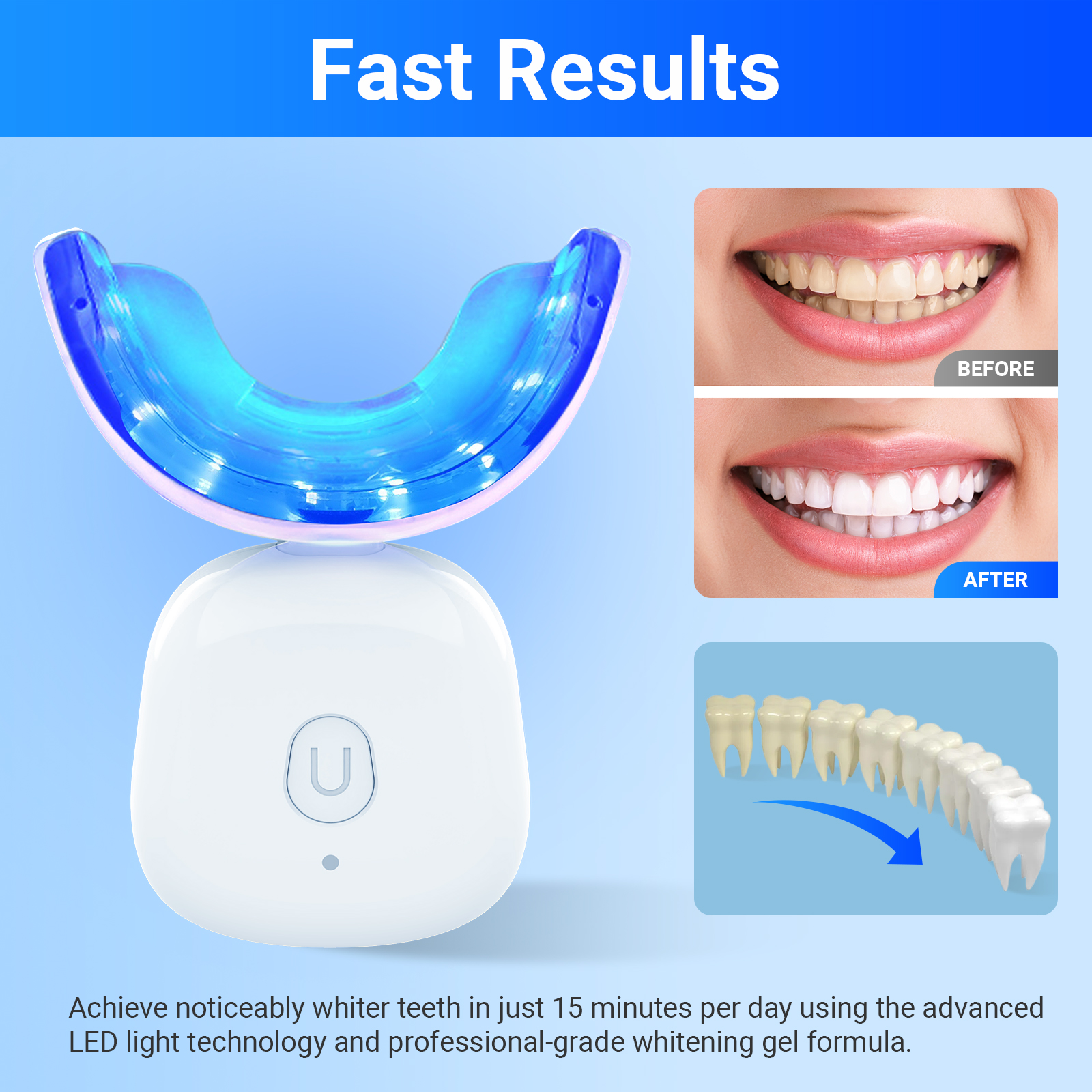 Teeth Whitening Kit
